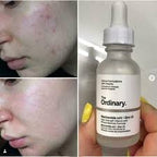 The Ordinary Niacinamide 10% + Zinc 1% – 30ml -100% original