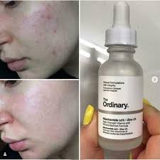 The Ordinary Niacinamide 10% + Zinc 1% – 30ml -100% original
